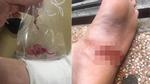 Hà Nội: Thanh niên suýt bị cưa chân vì... cục bông gòn bác sĩ 