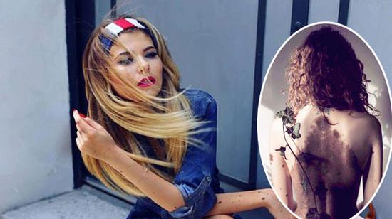 Cô gái với nốt ruồi kín toàn thân trở nên nổi tiếng trên Instagram