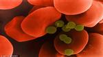 Nhiễm trùng máu: Căn bệnh có thể giết người chỉ sau vài giờ