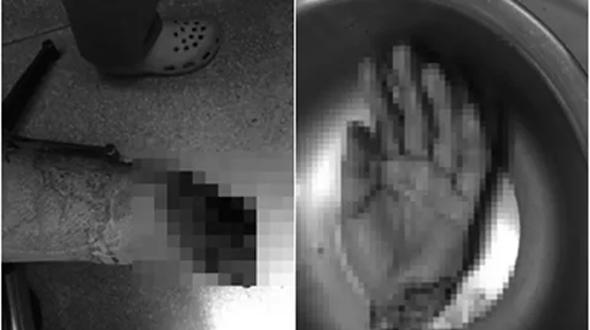 Thanh niên 22 tuổi bị máy cưa gỗ cắt đôi cơ thể-3