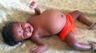Bé gái mới 15 tháng tuổi mang bào thai nặng 3.5kg trong cơ thể
