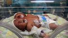 Bé gái hai đầu chào đời tại Indonesia