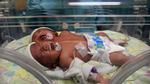 Bé gái hai đầu chào đời tại Indonesia