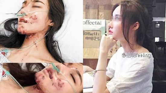 MC Trung Quốc bị tai nạn biến dạng mặt