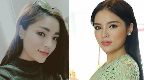 Bơm môi và những hệ luỵ khôn lường mà bạn nên phòng trước