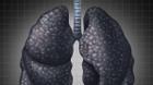 Đây là nguyên nhân và triệu chứng của bệnh ung thư phổi ở những người không hút thuốc