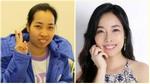 Cô gái 8x Phú Thọ đổi đời nhờ phẫu thuật chỉnh hàm hô