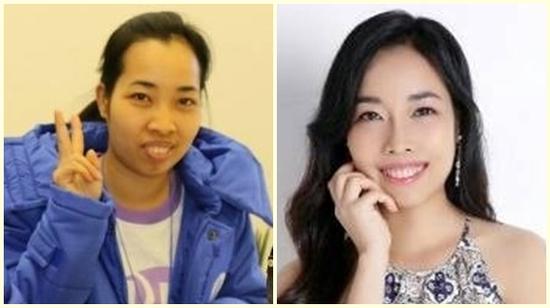 Cô gái 8x Phú Thọ đổi đời nhờ phẫu thuật chỉnh hàm hô