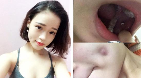 Chỉ vì hút mụn, cô gái này có nguy cơ mặt bị hoại tử, biến dạng