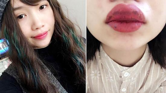 Nhìn môi sưng tều như cô gái này bạn có còn đủ can đảm đi xăm?