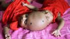 Cặp song sinh dính liền đỉnh đầu ở Bangladesh