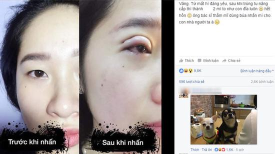 Chị em giật mình xôn xao vì cô gái trẻ đi nhấn mí bị sưng trông như... đắp bì lợn lên mắt