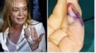Hãi hùng với những hình ảnh mất nửa ngón tay của Lindsay Lohan