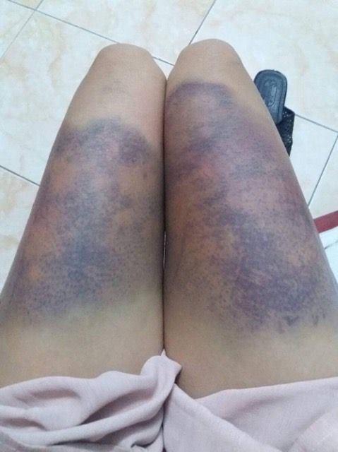 Hà Nội: Cô gái trẻ “tố” bị bạn trai ghen tuông, đánh đập thâm tím hết cả người - Ảnh 2.