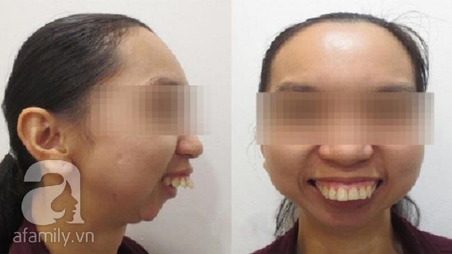 Cô gái “răng chuột” qua 45 lần phẫu thuật, 30 năm không thể ngủ nằm được cứu vớt cuộc đời - Ảnh 3.