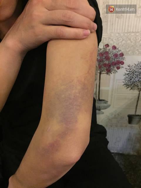 Nỗi kinh hoàng của cô gái sau khi bị bạn trai đánh dã man, thâm tím hết cả người - Ảnh 3.