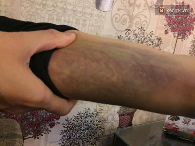 Nỗi kinh hoàng của cô gái sau khi bị bạn trai đánh dã man, thâm tím hết cả người - Ảnh 2.