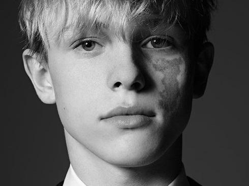 Vẻ đẹp hút hồn của anh chàng người mẫu bị bỏng nửa khuôn mặt