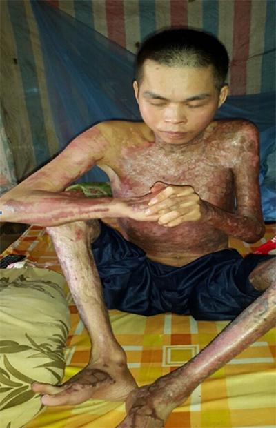 7-lan-phau-thuat-giup-nguoi-dan-ong-tan-phe-hoi-sinh