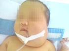 Bé sơ sinh có khối u chứa xương và tóc lần đầu phát hiện tại Việt Nam