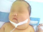 Bé sơ sinh có khối u chứa xương và tóc lần đầu phát hiện tại Việt Nam
