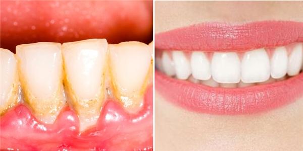 Răng ố vàng trở trắng sáng tức thì bằng những mẹo nhỏ dưới đây.