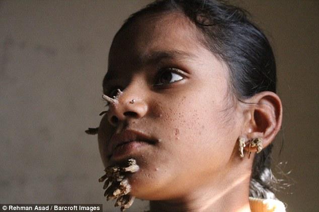 Khuôn mặt biến dạng, mọc rễ của cô bé 10 tuổi do căn bệnh người cây quái ác - Ảnh 2.