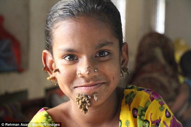 Khuôn mặt biến dạng, mọc rễ của cô bé 10 tuổi do căn bệnh người cây quái ác - Ảnh 1.