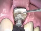 Trồng răng Implant: Ai nên cấy ghép màng xương?