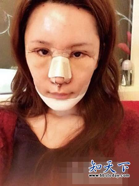 Đòi xinh đẹp như Angela Baby, mẫu nữ Hồng Kông trả giá đắt với chiếc mũi phẫu thuật thẩm mỹ... lệch - Ảnh 4.