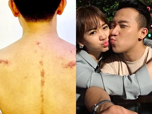 Đánh gió cho chồng bị cảm, Hari Won khiến Trấn Thành xấu hổ 'khóc không thành tiếng'