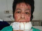 Người phụ nữ Thái Lan bị chồng tẩm xăng thiêu sống vì ghen