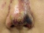 Thiếu nữ 17 hoại tử mũi vì nâng ở spa