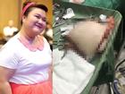 Á quân 'Bước nhảy ngàn cân' Thủy Tiên tiết lộ hình ảnh đại phẫu hút mỡ khiến ai cũng shock