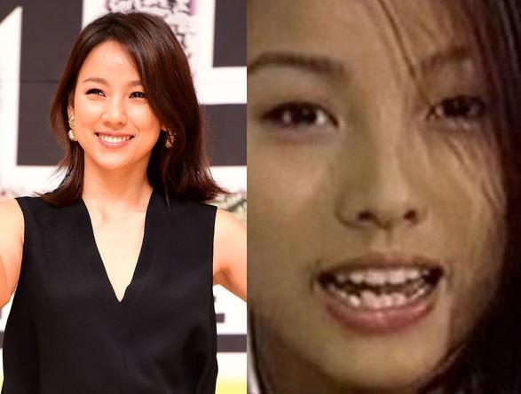 Nữ ca sĩ bốc lửa Lee Hyo-ri trở nên rạng ngời và bớt quê khi bọc sứ lại bộ nhai của mình.