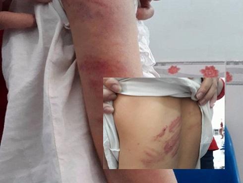 Bố say rượu liên tục đánh, đạp vào bụng con gái 9 tuổi ở Vĩnh Phúc