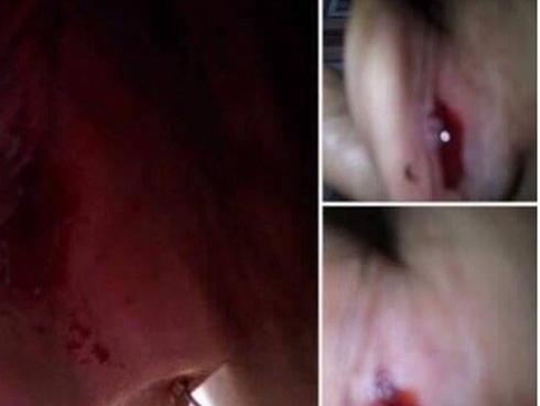 Cô giáo mầm non 'quệt tay' làm chảy máu tai trẻ 4 tuổi