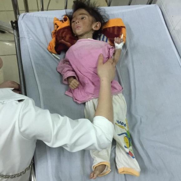 bé gái Lào Cai 14 tháng tuổi nặng 3,5kg, bé gái Lào Cai 14 tháng tuổi nặng 3,5kg hiện nay, Bé Yến Nhi