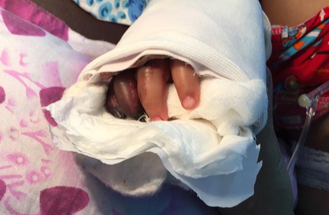 Bé trai bị thang cuốn ở sân bay Tân Sơn Nhất phải cắt một ngón tay - Ảnh 1.