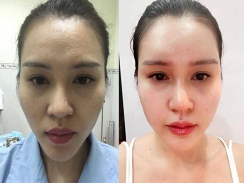 Cấy mỡ tự thân - phương pháp làm đẹp cực hot nhờ 'một mũi tên trúng hai đích'