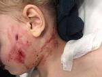 Clip: Kinh hoàng bé trai 3 tuổi bị chó pitbull cắn rách mặt
