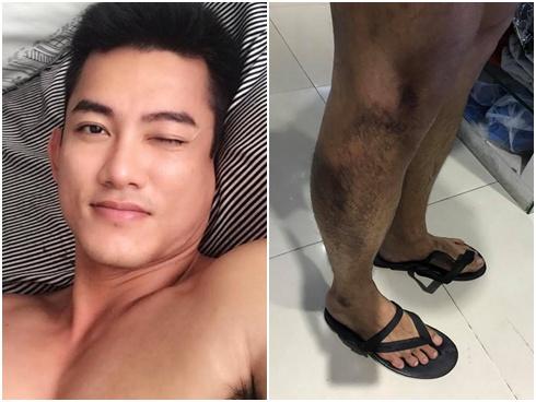 Lăn khỏi gầm xe tải, người mẫu Lê Trung Cương thoát chết trong gang tấc