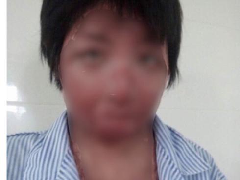 9X xinh đẹp biến dạng toàn bộ gương mặt do bị chồng tẩm xăng đốt