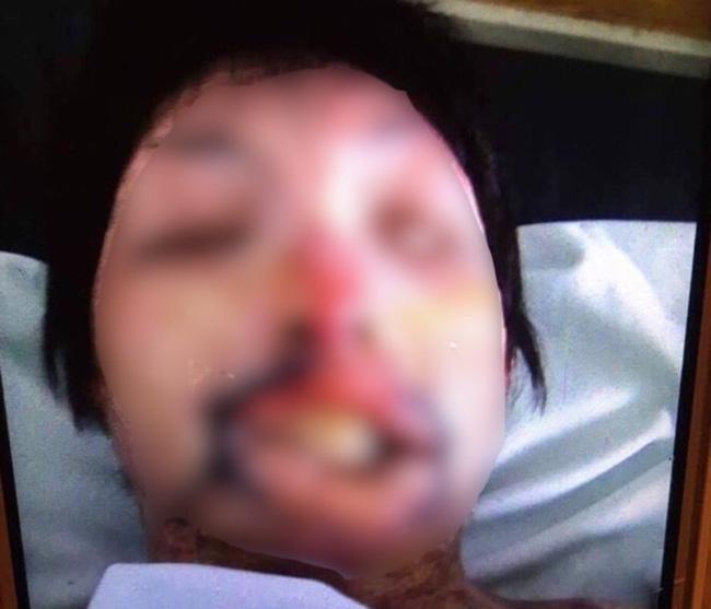 9X xinh đẹp biến dạng toàn bộ gương mặt do bị chồng tẩm xăng đốt - Ảnh 1.