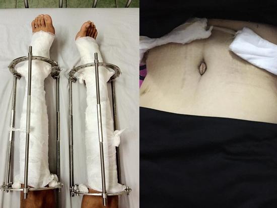 Những pha cắt xương sườn, kéo dài chân của giới trẻ Việt khiến nhiều người 'hoảng sợ'