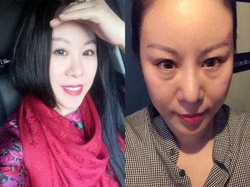 Ca sĩ Ngọc Ánh Kim cảnh báo hậu quả khôn lường khi làm đẹp bằng cấy mỡ tự thân