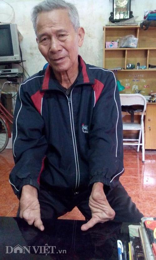 la lung gia dinh co 3 doi mac benh ban tay, ban chan mot ngon hinh anh 1