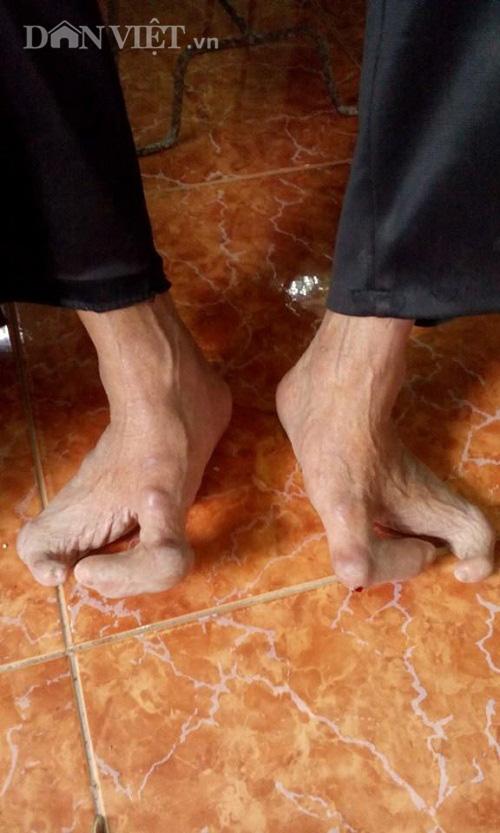la lung gia dinh co 3 doi mac benh ban tay, ban chan mot ngon hinh anh 4