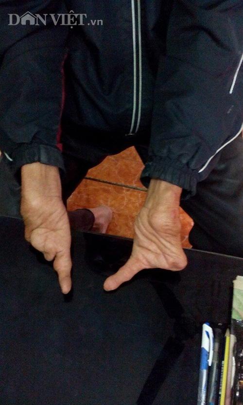 la lung gia dinh co 3 doi mac benh ban tay, ban chan mot ngon hinh anh 5