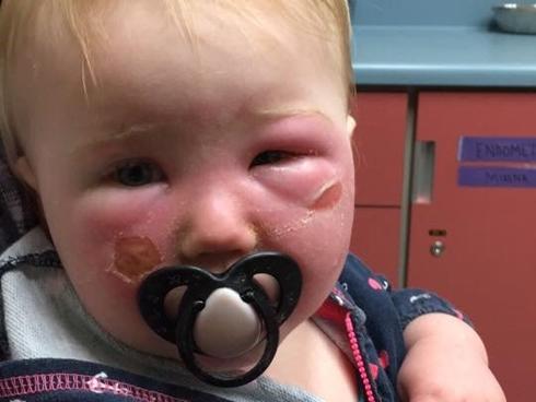 Mẹ trẻ gửi khuyến cáo sau khi con gái 14 tháng tuổi bị bỏng kem chống nắng